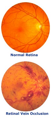 Diagram showing Normal retina vs retina with Retinal Vein Occlusion.